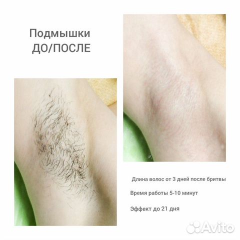 Мужская депиляция