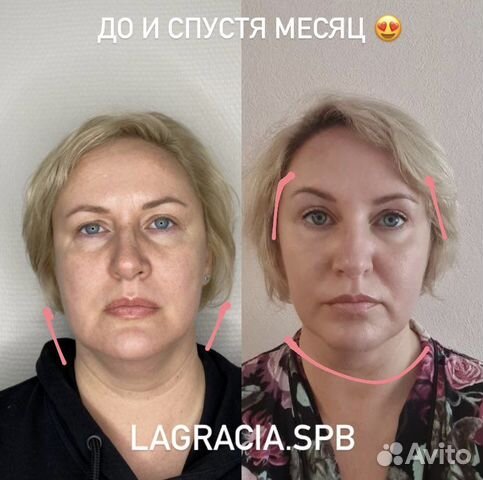 Модель SMAS lifting